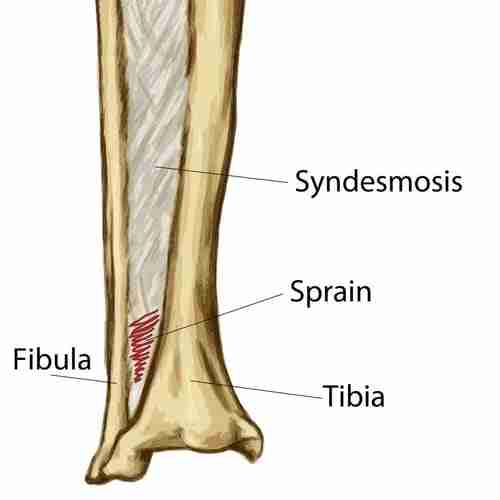 High ankle sprains body diagram